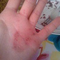 Hhhrôza menom Ekzém(asi alergia na gumove rukavice)..:(